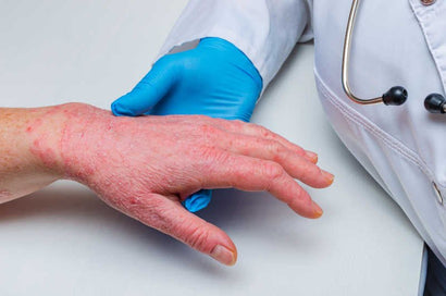 Can You Be Allergic to Nitrile Gloves?